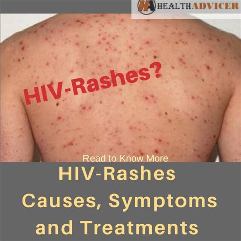 rash hiv - sintomas hiv fotos